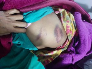 कुटपिटबाट पूजाको शरीरमा बनेका निलडाम ।